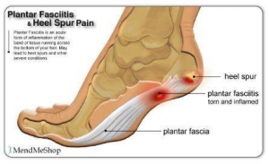 planter fascitis