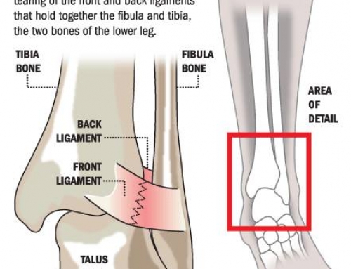 Foot and Ankle Injuries That Can Trip Up Runners