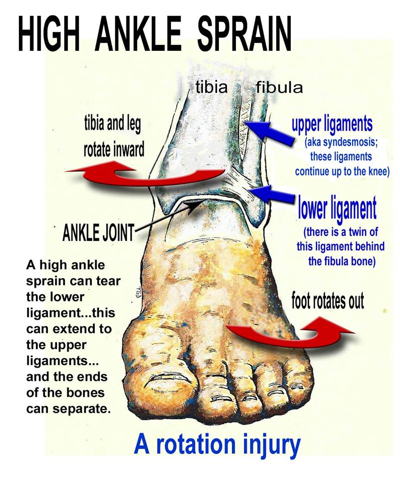 Pathophysiology Of Sprained Ankle