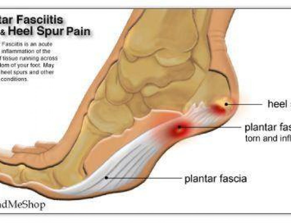 Dry needling aims to relieve pain Energise Therapy